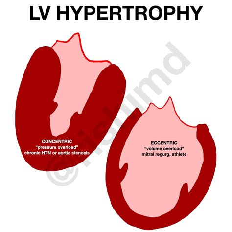 eccentric hypertrophy